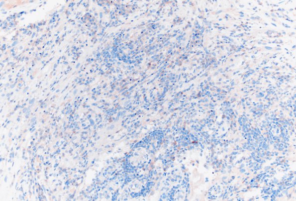 18B Metastasis, renal (Case 18) Inhibin