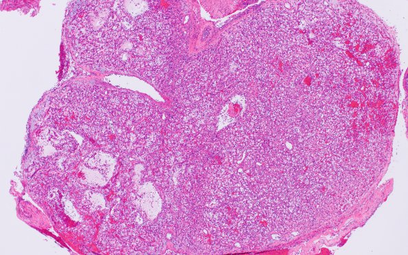 19A1 Metastasis, renal (case 19) H&E 5