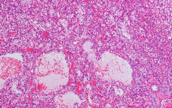 19A3 Metastasis, renal (Case 19) H&E 2