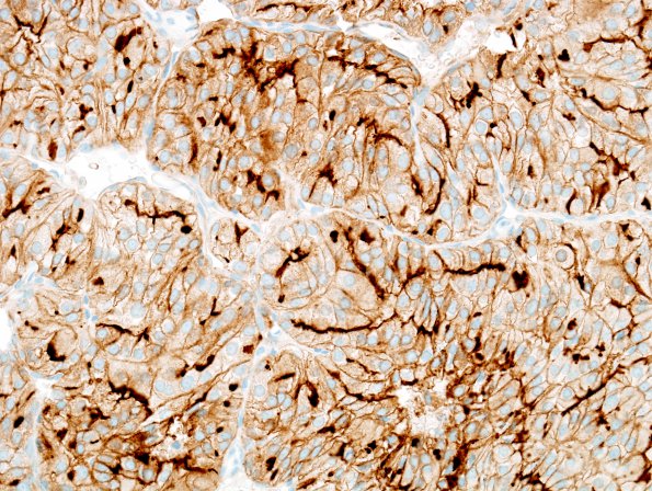 19B Metastasis, renal (Case 10) CD10 2