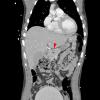 1A1 Hemangioblastoma (Case 1, Von Hippel Lindau) CT 27 copy - Copy