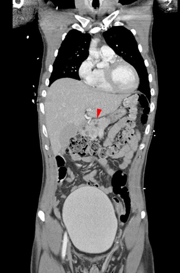 1A1 Hemangioblastoma (Case 1, Von Hippel Lindau) CT 27 copy - Copy