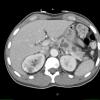 1A2 Hemangioblastoma (Case 1, Von Hippel Lindau) CT 132 - Copy