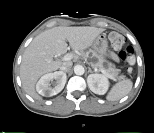 1A2 Hemangioblastoma (Case 1, Von Hippel Lindau) CT 132 - Copy