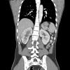 1A3 Hemangioblastoma (Case 1, Von Hippel Lindau) CT 52 - Copy