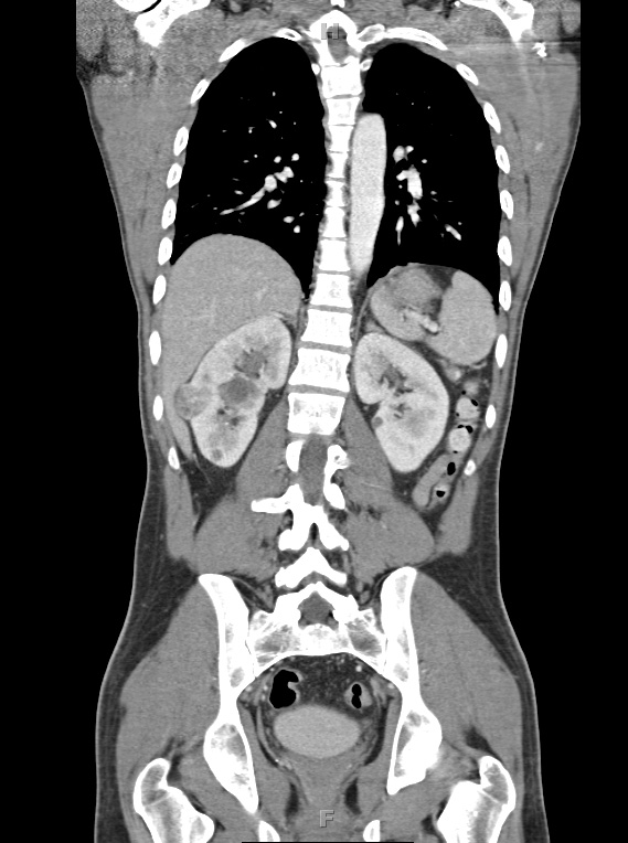 1A3 Hemangioblastoma (Case 1, Von Hippel Lindau) CT 52 - Copy