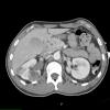 1A4 Hemangioblastoma (Case 1, Von Hippel Lindau) CT 149 - Copy