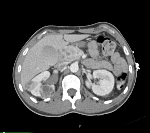 1A4 Hemangioblastoma (Case 1, Von Hippel Lindau) CT 149 - Copy