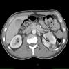 1A5 Hemangioblastoma (Case 1, Von Hippel Lindau) CT 158 - Copy