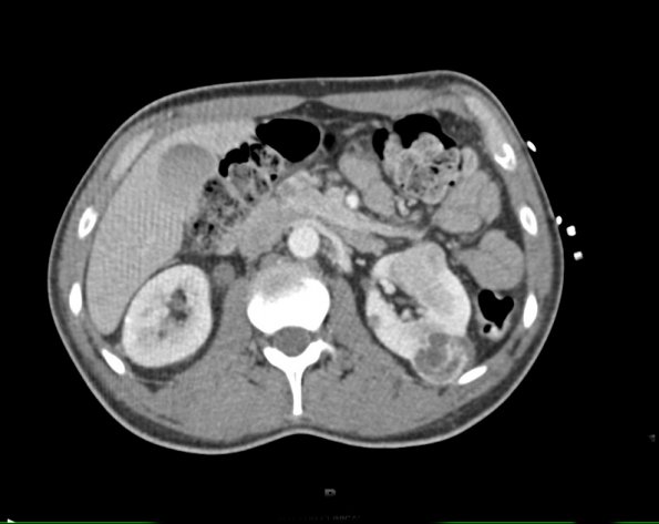 1A5 Hemangioblastoma (Case 1, Von Hippel Lindau) CT 158 - Copy