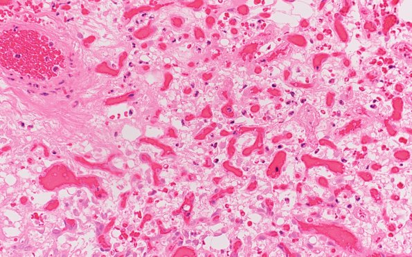 1B3 Hemangioblastoma (Case 1, Von Hippel Lindau) H&E 40X