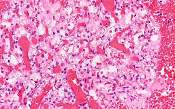 1B4 Hemangioblastoma (Case 1, Von Hippel Lindau) H&E 40X 2