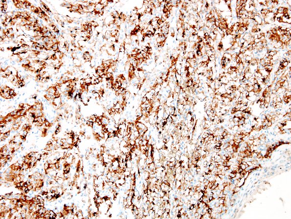 20B1 Metastasis, renal (Case 20) CD10 2.jpg