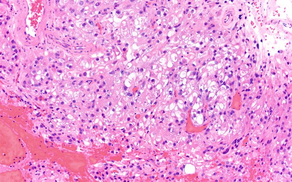 21A1 Metastasis, renal origin (Case 21) H&E 3