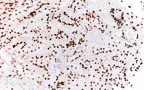 21B1 Metastasis, renal origin (Case 21) PAX-8 1