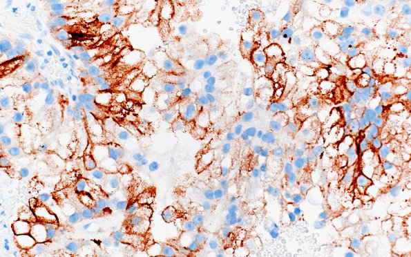 21B2 Metastasis, renal origin (Case 21) RCC 1