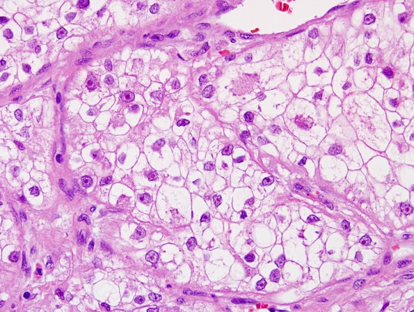 22A2 Metastasis, renal (Case 22) H&E 2.jpg