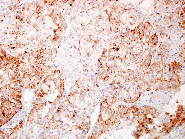 22B1 Metastasis, renal (Case 22) CD10.jpg