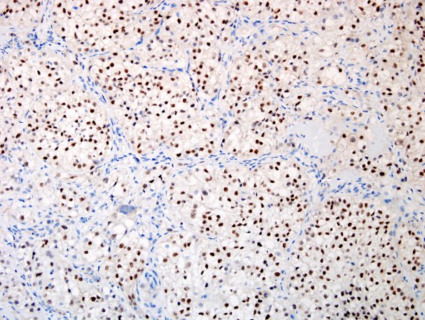 22B2 Metastasis, renal (Case 22) H&E PAX-8.jpg