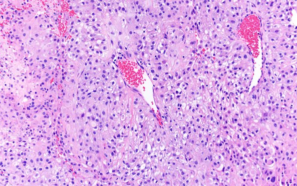 23A Metastasis, renal (Case 23) H&E 1