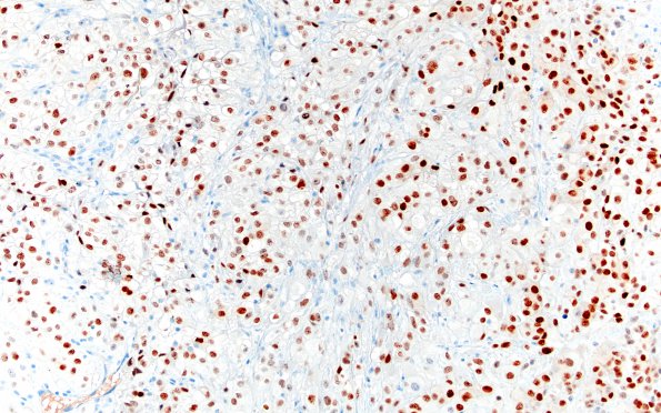 23B Metastasis, renal (Case 23) PAX 8 1