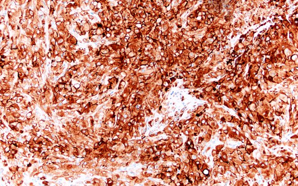 23C Metastasis, renal (Case 23) EMA 1