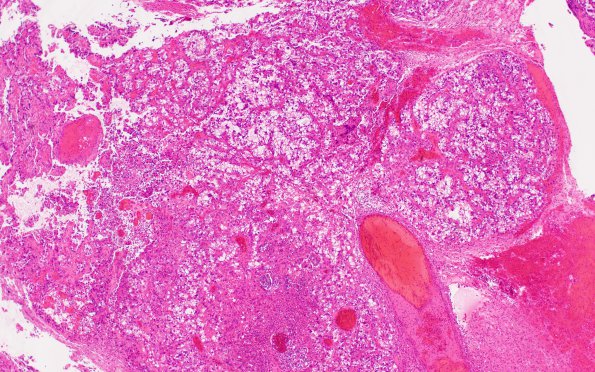 24A1 Metastasis, renal cell (Case 24) H&E 4