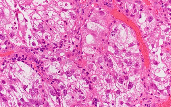 24A2 Metastasis, renal cell (Case 24) H&E 3