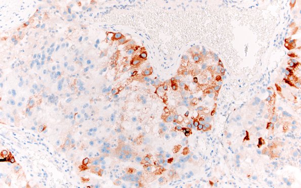 24B3 Metastasis, renal cell (Case 24) Inhibin 1