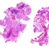 25A1 Metastasis, renal cell CA (Case 25) H&E whole mount