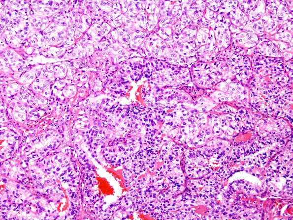 25A2 Metastasis, renal cell CA (Case 25) H&E 1