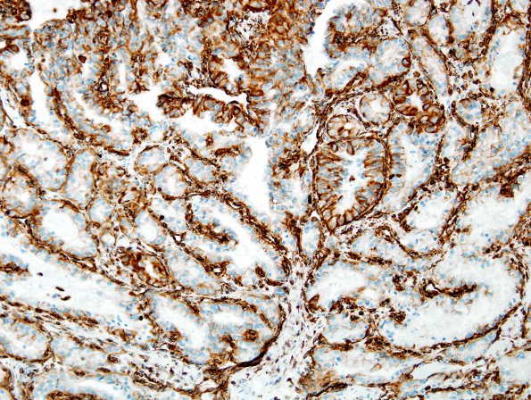 25B1 Metastasis, renal cell CA (Case 25)  Vim