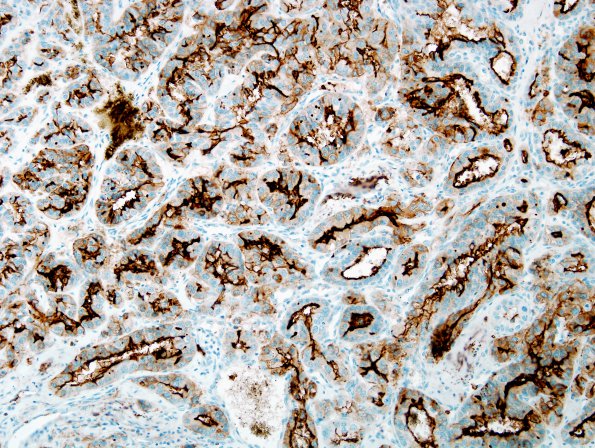 25B2 Metastasis, renal cell CA (Case 25)  CD10