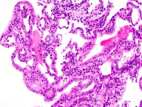 26A1 Endolymphatic Sac Tumor (Case 26) 1.jpg