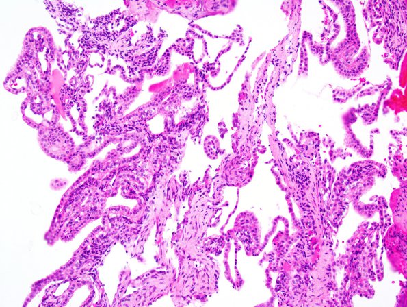 26A2 Endolymphatic Sac Tumor (Case 26) 2.jpg