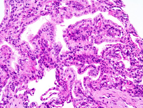 26A3 Endolymphatic Sac Tumor (Case 26) 3.jpg