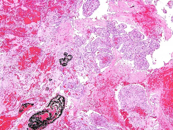 27A1 Endolymphatic sac tumor (Case 27) H&E 10.jpg