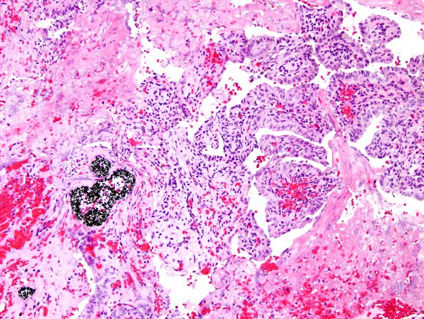 27A2 Endolymphatic sac tumor (Case 27) H&E 4.jpg