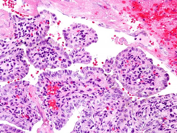 27A3 Endolymphatic sac tumor (Case 27) H&E 2.jpg