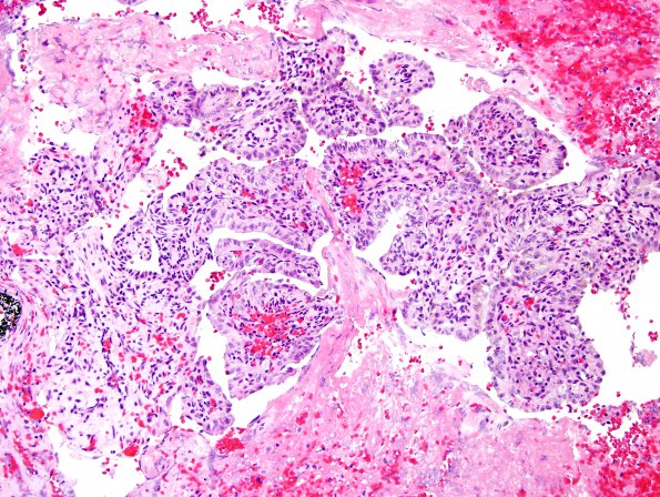 27A4 Endolymphatic sac tumor (Case 27) H&E 5.jpg