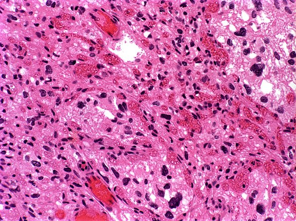 28A Hemangioblastoma (Case 28) H&E 1