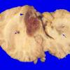 29A1 Hemangioblastoma (Case 29) 4 copy