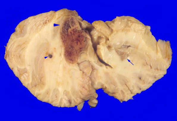 29A1 Hemangioblastoma (Case 29) 4 copy