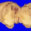 29A2 Hemangioblastoma (Case 29) 5