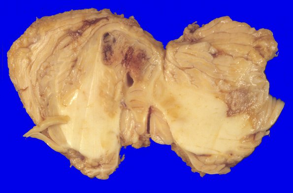 29A2 Hemangioblastoma (Case 29) 5