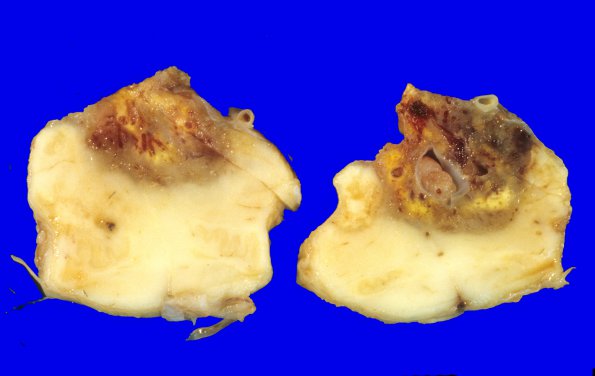 29B1 Hemangioblastoma (Case 29) 9