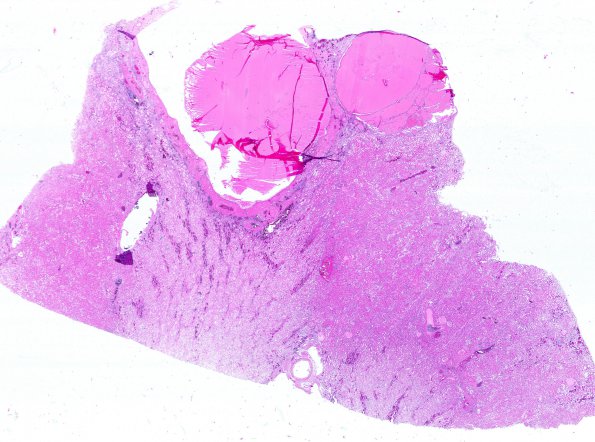 29D1 (Case 29) Renal 3