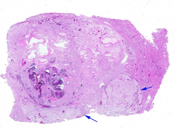 29D3 (Case 29) Renal 1 copy