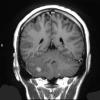 2A Hemangioblastoma, VHL (Case 2) T1 W 3 - Copy