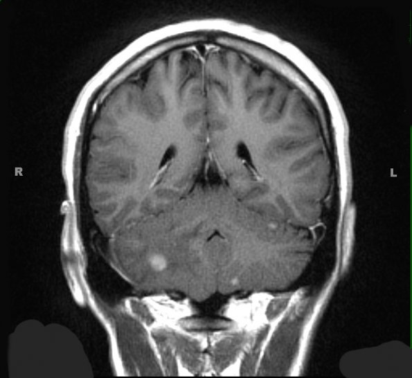 2A Hemangioblastoma, VHL (Case 2) T1 W 3 - Copy